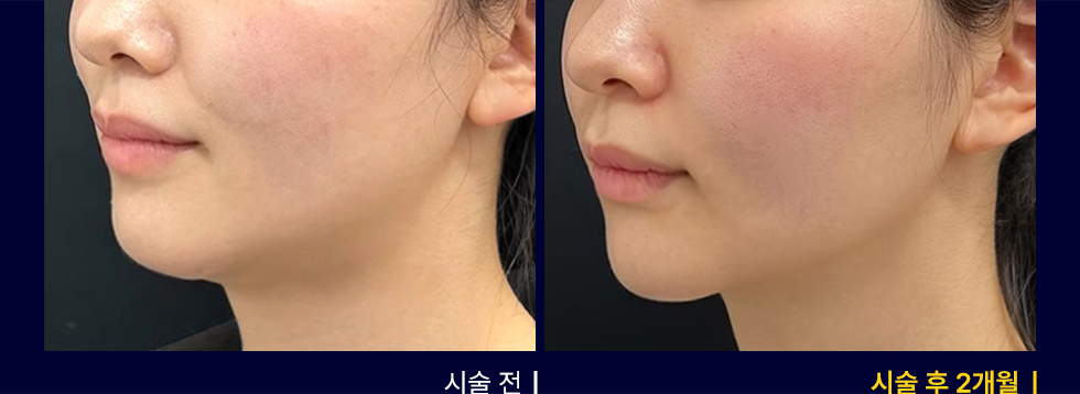 전후사진