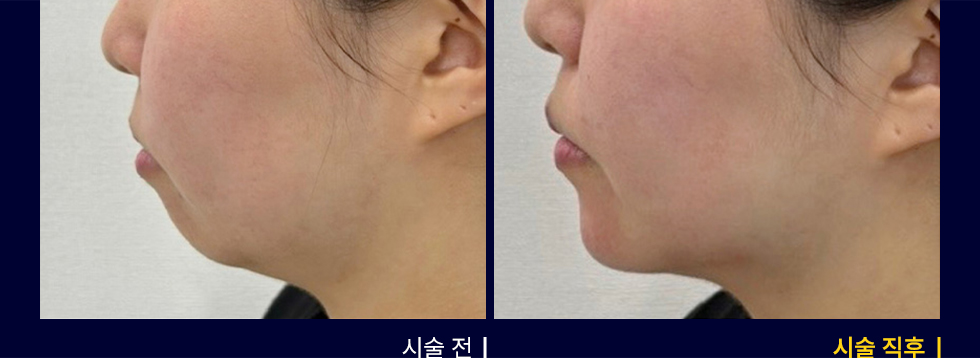 전후사진