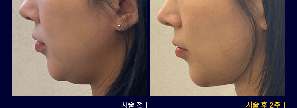 전후사진