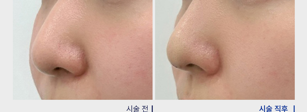 전후사진