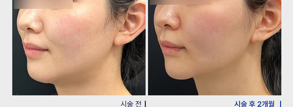 전후사진