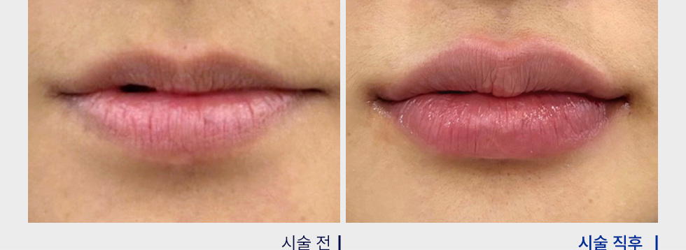 전후사진
