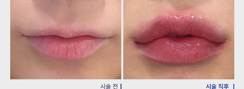 전후사진