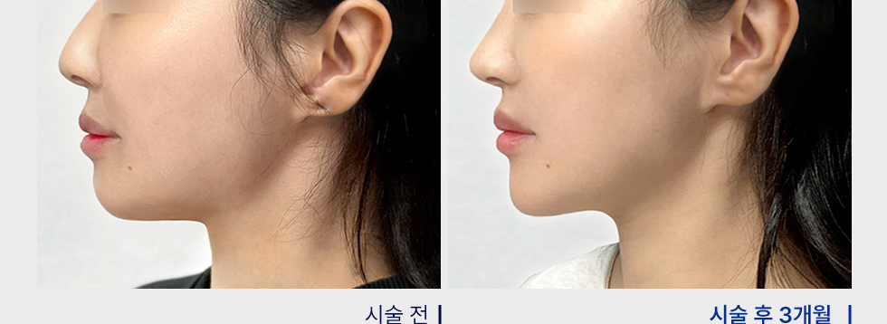 전후사진