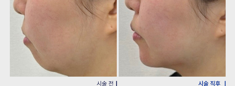 전후사진