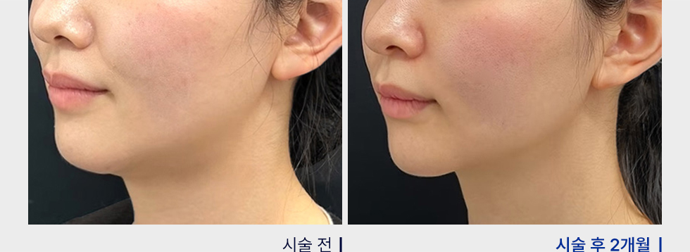 전후사진
