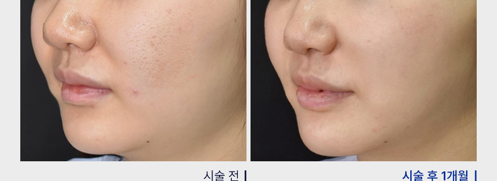 전후사진