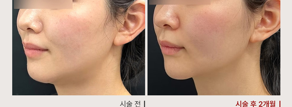 전후사진