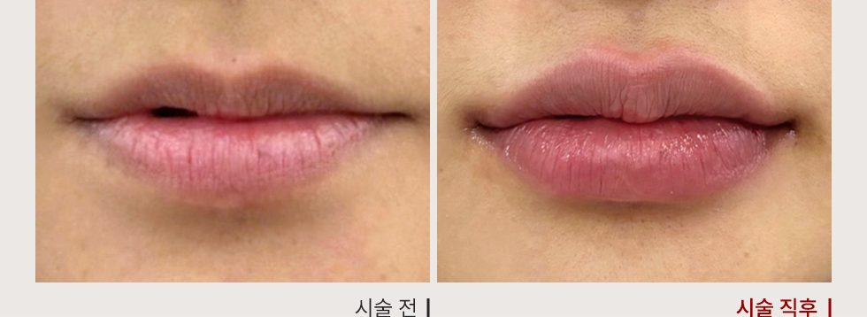 전후사진
