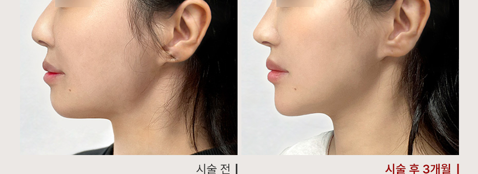 전후사진