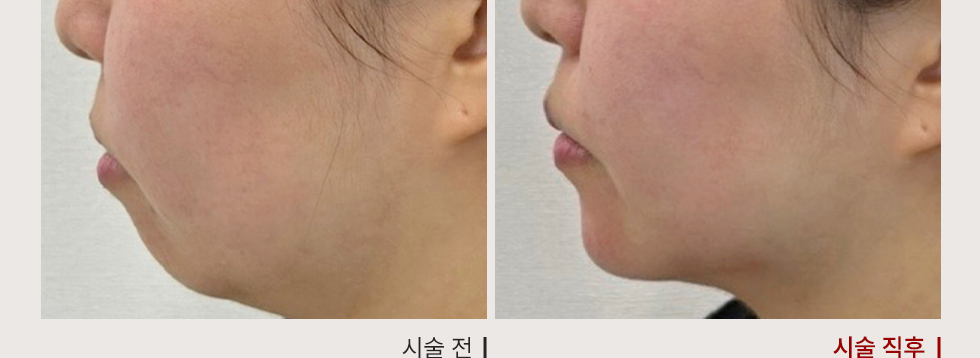 전후사진