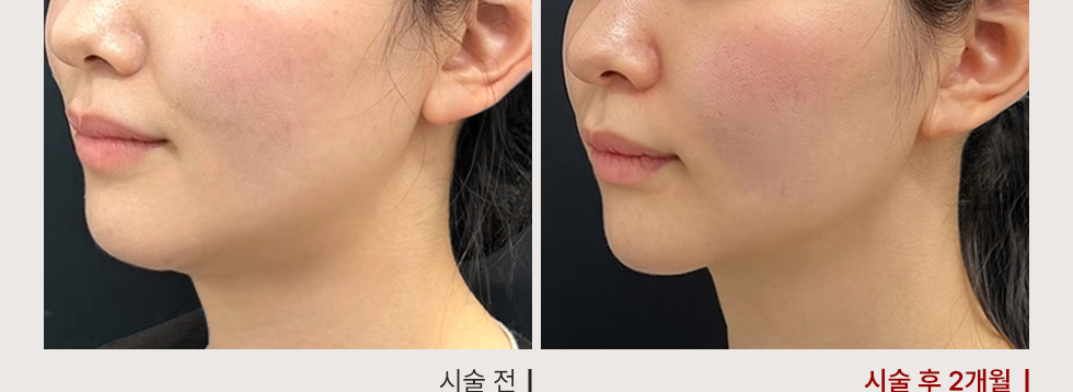 전후사진