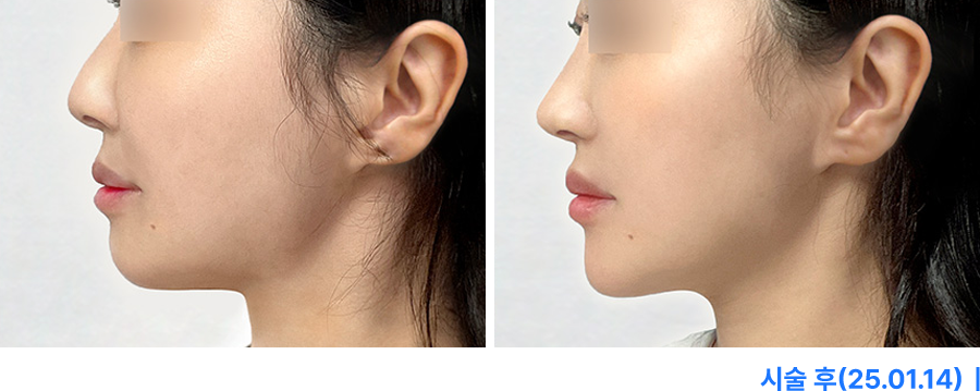 전후사진