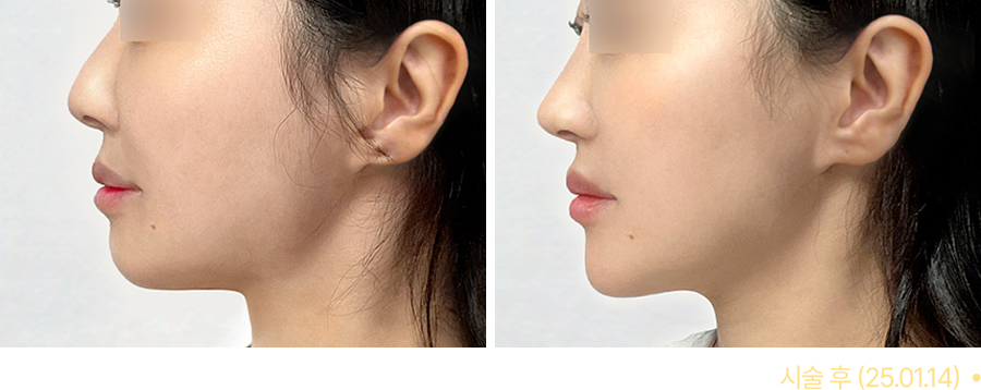 전후사진