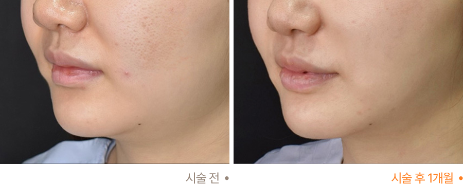 전후사진